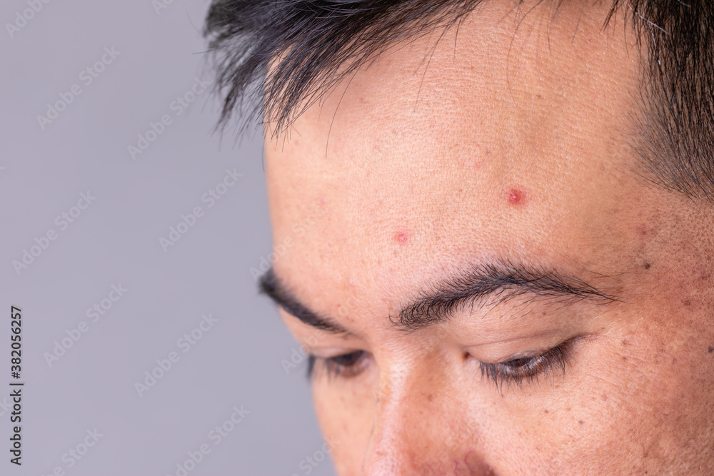 Obraz premium Face skin of asian man to show many skin problem. Men skin care concept on grey space background