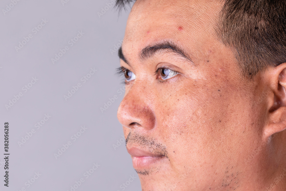 Obraz premium Face skin of asian man to show many skin problem. Men skin care concept on grey space background