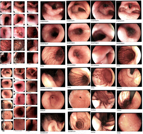 Obraz na plátně Collection Gastrointestinal endoscopic examination image showing acute on chronic gastritis