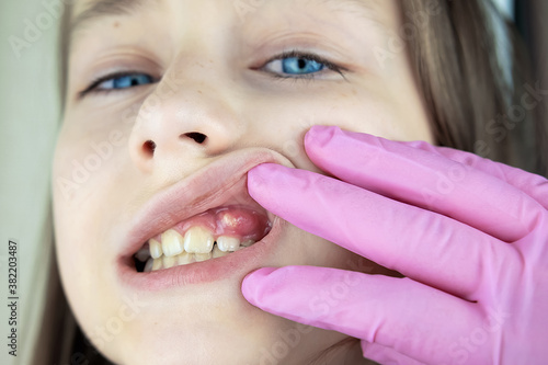 The child has swollen gums with hematoma and fistula