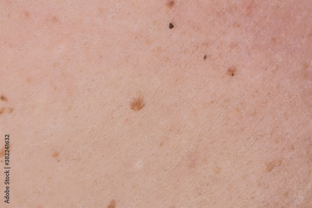 Risk of melanoma formation on the skin