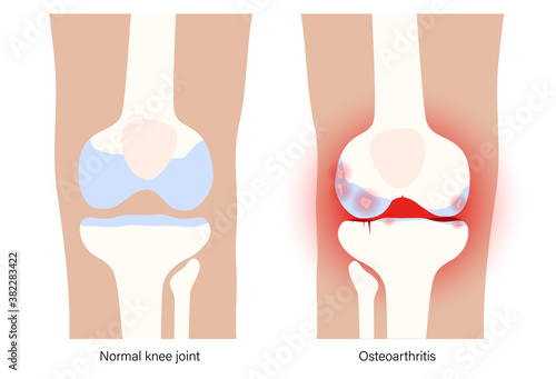 Arthritis in knee joint