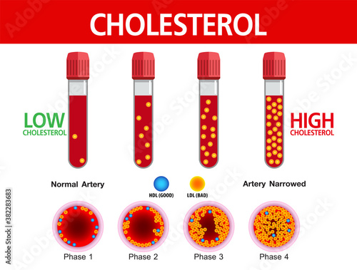 Cholesterol in artery, health risk , vector design