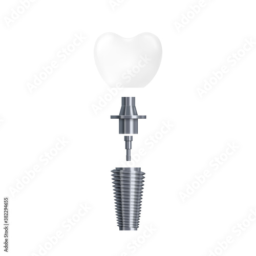 3d realistic illustration of dental tooth implant and its parts vector isolated icon
