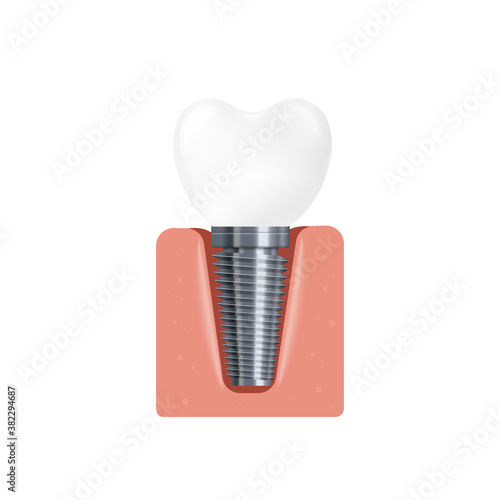 Realistic 3d isolated vector illustration of a dental implant in the gum