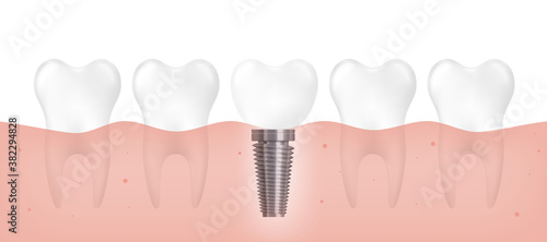 Realistic dental implant among healthy teeth row on gums.