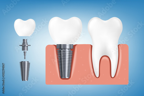 Banner with healthy tooth and dental implant realistic vector illustration.