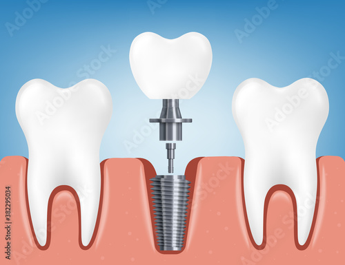 Fototapeta Naklejka Na Ścianę i Meble -  Installing a dental implant a realistic 3D vector illustration