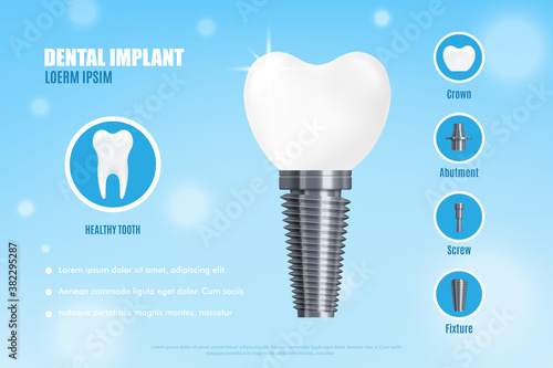 Advertisement poster with realistic 3d vector illustration dental implant structure