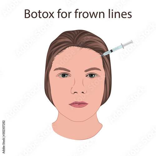 Botox for frown lines. Young woman face with syringe. Vector illustration.