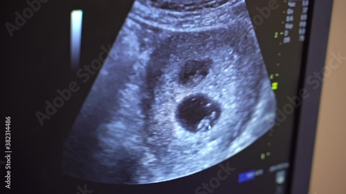 Sonography. The screen of the ultrasound machine. Results of the ultrasound on the monitor. Health care concept.