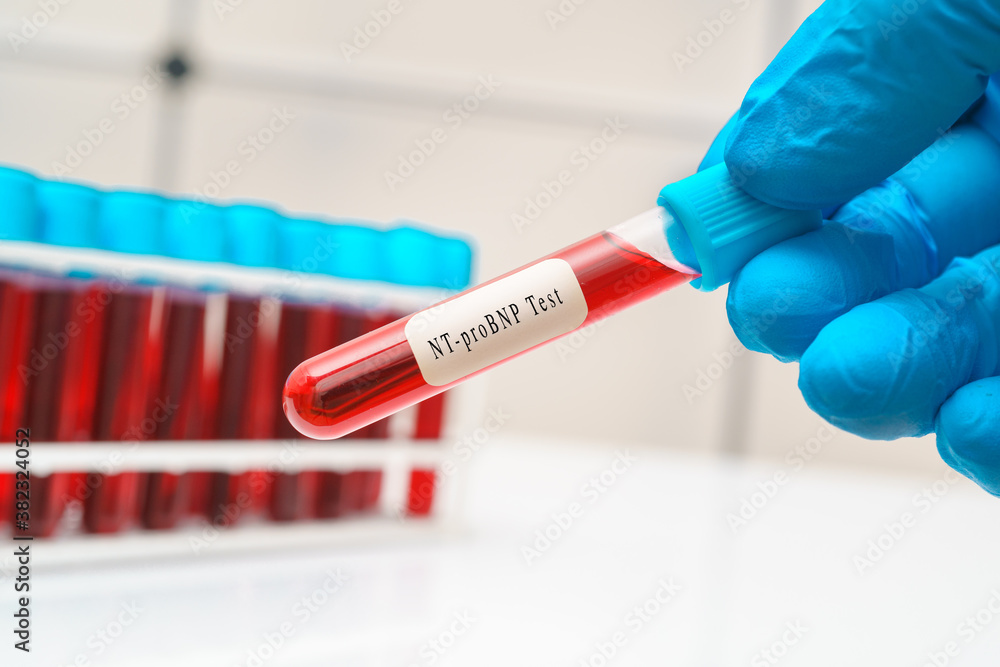 Blood sample test tube in doctor hand for NT-proBNP test Blood sample test tube in doctor hand for NT-proBNP test