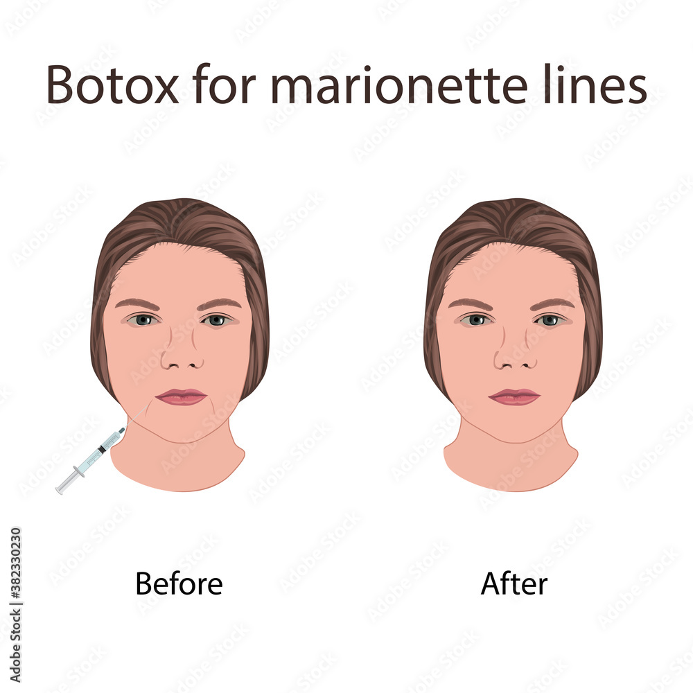 Botox for lines. Young woman face with syringe. Before and