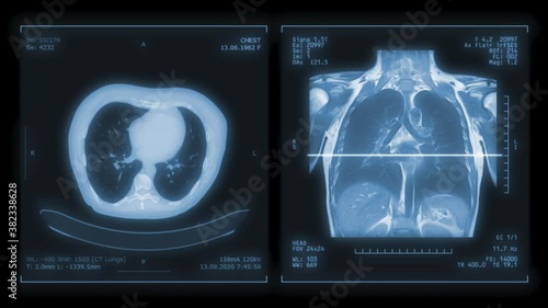 CT Chest or CT Scan of Human Chest Coronal MIP View with Lung filter technique for diagnosis TB,tuberculosis and covid-19 .