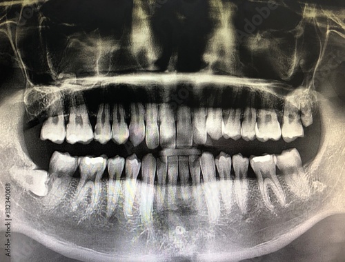 X-ray photograph of teeth of human