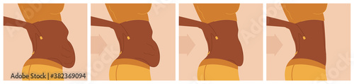 African American girl mommy belly transformation concept. Flab on belly. Before after. Result of diet, fitness, liposuction.