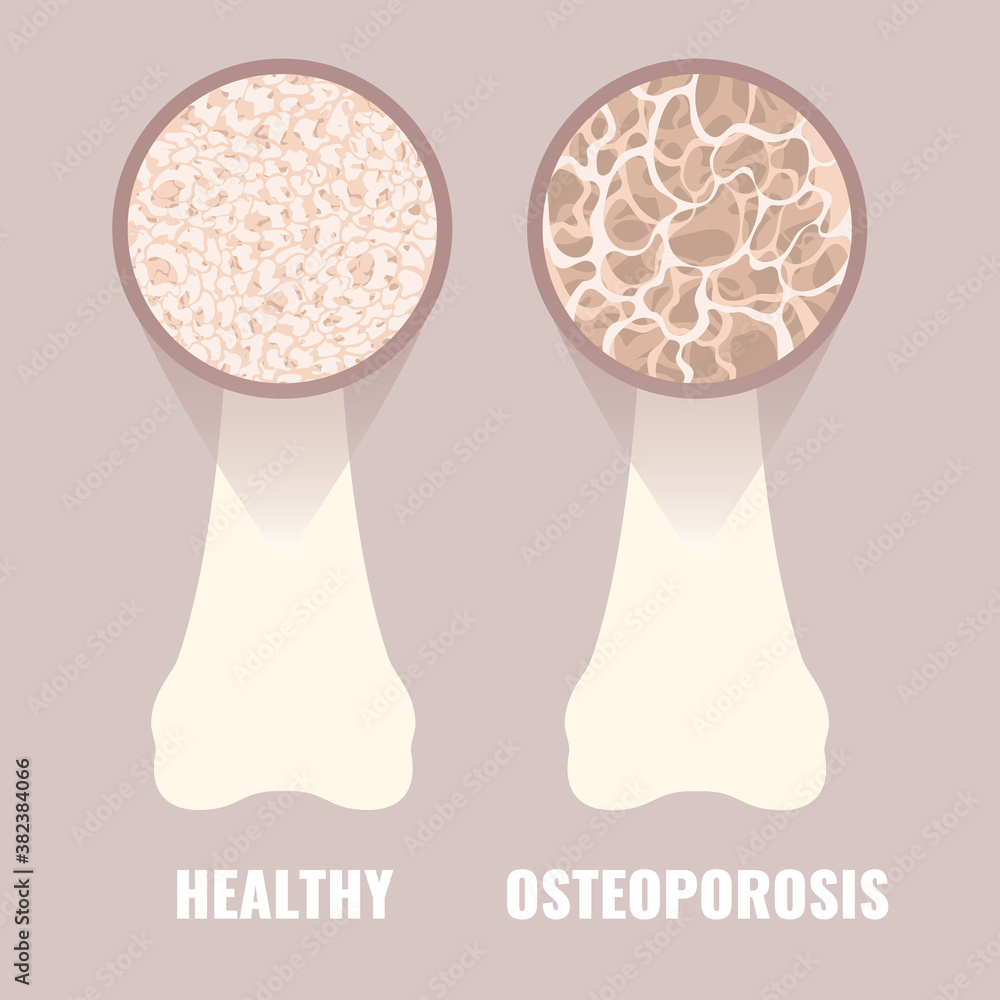 Healthy and osteoporotic bone under the microscope. Different bone