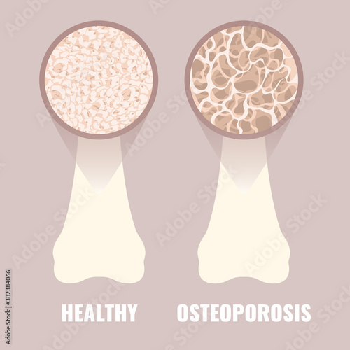 Healthy and osteoporotic bone under the microscope. Different bone tissue density close-up. Skeletal system disease. Senior osteopathy medical concept. Vector illustration.