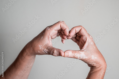 Caucasian hands with vitiligo skin disorder forming a heart with fingers on isolated background. photo