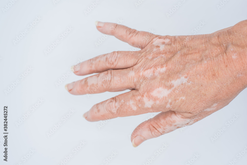 Vitiligo skin disease on hand closeup on isolated white background. Vitiligo skin disease on hand closeup on isolated white background.