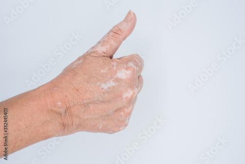 Hand with vitiligo disorder with thumb up as a sign of acceptance and victory on white background