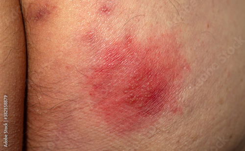 Shingles (disease). Sympton of the Herpes virus on the human body. Skin rash and blisters on the body photo