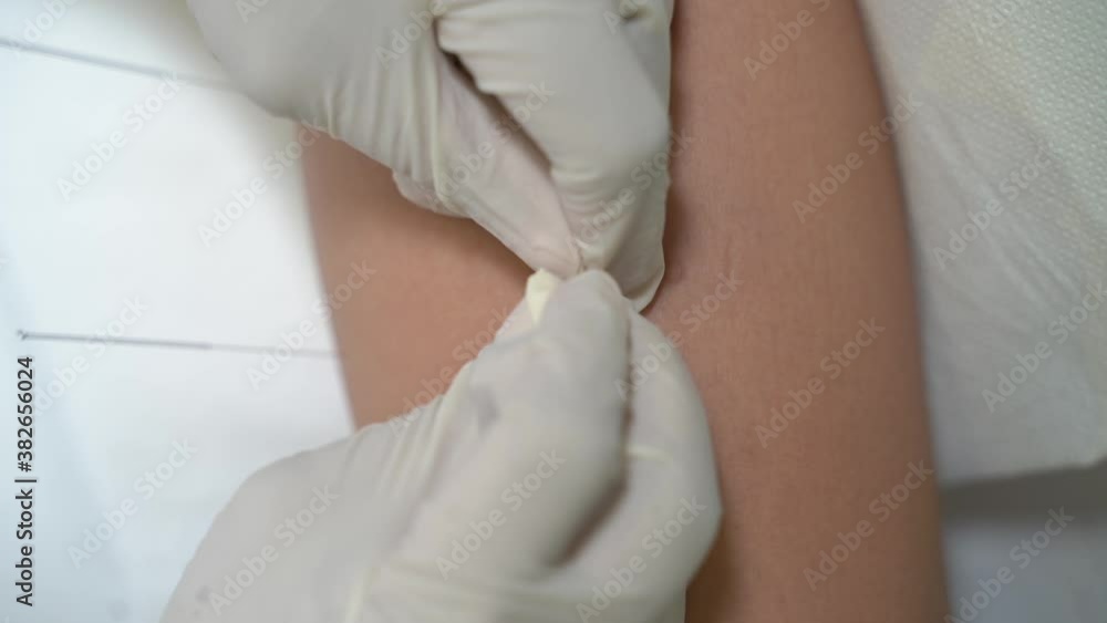 needles stick into a woman's hands. acupuncture needles stick into a woman's hands. acupuncture