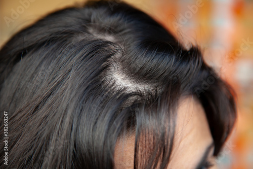 Bilde på lerret Woman shows thinning hair near the root with oily hair problems.