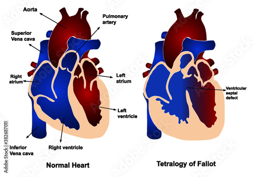 Congenital heart disease: Tetralogy of Fallot