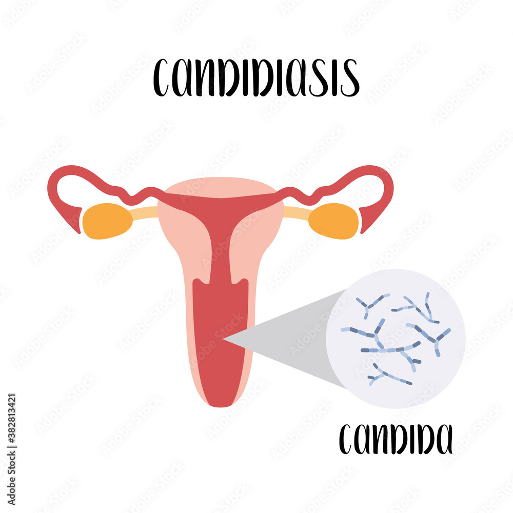 Candidiasis. Candida. Bacterial vaginal disease. Female reproductive ...