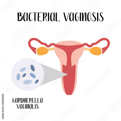 Bacterial vaginosis. Gardnerella vagіnalis. Bacterial vaginal disease. Female reproductive system. Gynecology. Vector flat cartoon illustration