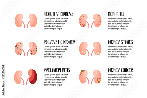 Kidneys diseases. Polycystic kidney, pyelonephritis, nephritis, stones, cancer. Urology. Vector flat illustration. Perfect for flyer, medical brochure, banner, landing page, website