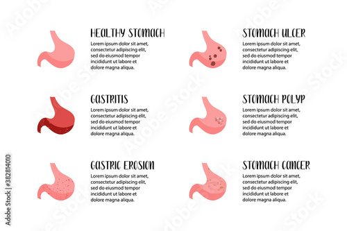 Stomach diseases. Gastritis, gastric erosion, ulcer, cancer, polyp. Gastroenterology. Vector flat illustration. Perfect for flyer, medical brochure, banner, landing page, website