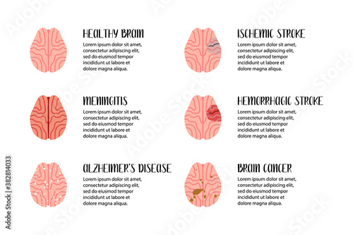 Brain diseases. Meningitis, ischemic and hemorrhagic stroke, alzheimer's disease, cancer. Neurobiology. Vector flat illustration. Perfect for flyer, medical brochure, banner, landing page, website