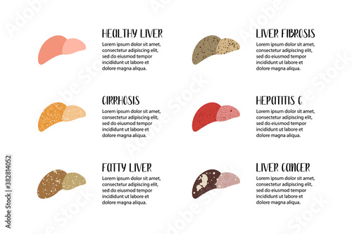 Healthy liver and various liver diseases. Hepatology. Stages of liver damage. Cirrhosis, fatty, fibrosis, hepatitis c, cancer. Vector flat illustration. Perfect for flyer, medical brochure, banner