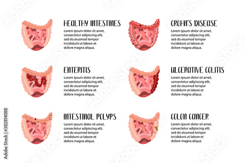 Intestines diseases. Enteritis, ulcerative colitis, Crohn's disease, polyp, colon cancer. Gastroenterology. Vector flat illustration. Perfect for flyer, medical brochure, banner, landing page, website