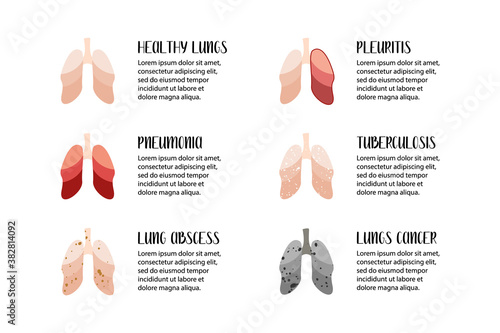 Lungs diseases. Pneumonia, lung abscess, pleuritis, tuberculosis, cancer. Pulmonology. Vector flat illustration. Perfect for flyer, medical brochure, banner, landing page, website