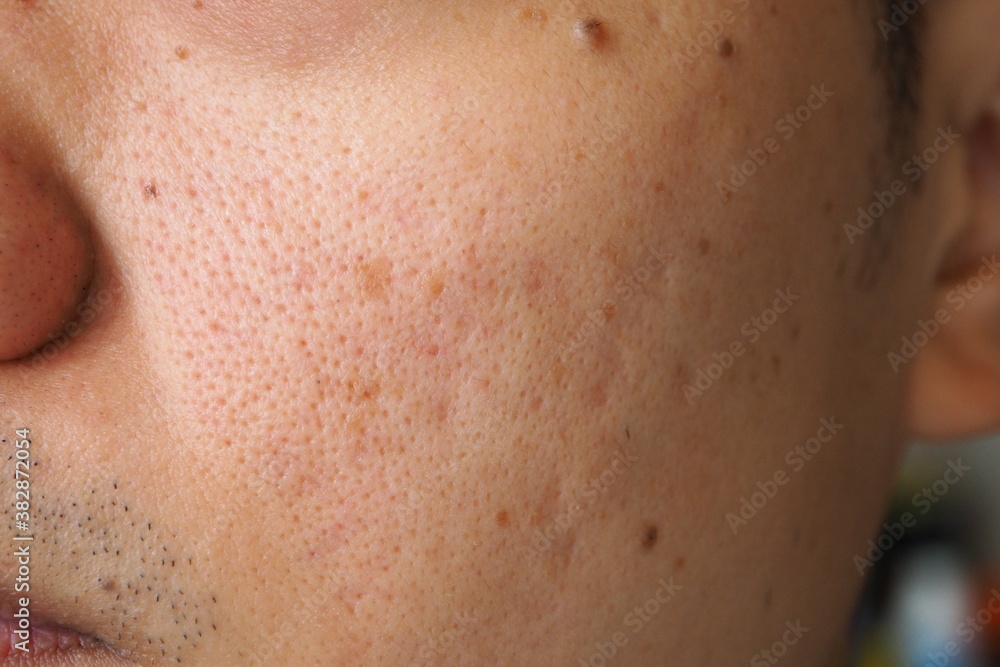 Closeup of red skin with acne, pores and moles on the face of a young Asian man. Health, medical, beauty, aesthetics concept Closeup of red skin with acne, pores and moles on the face of a young Asian man. Health, medical, beauty, aesthetics concept