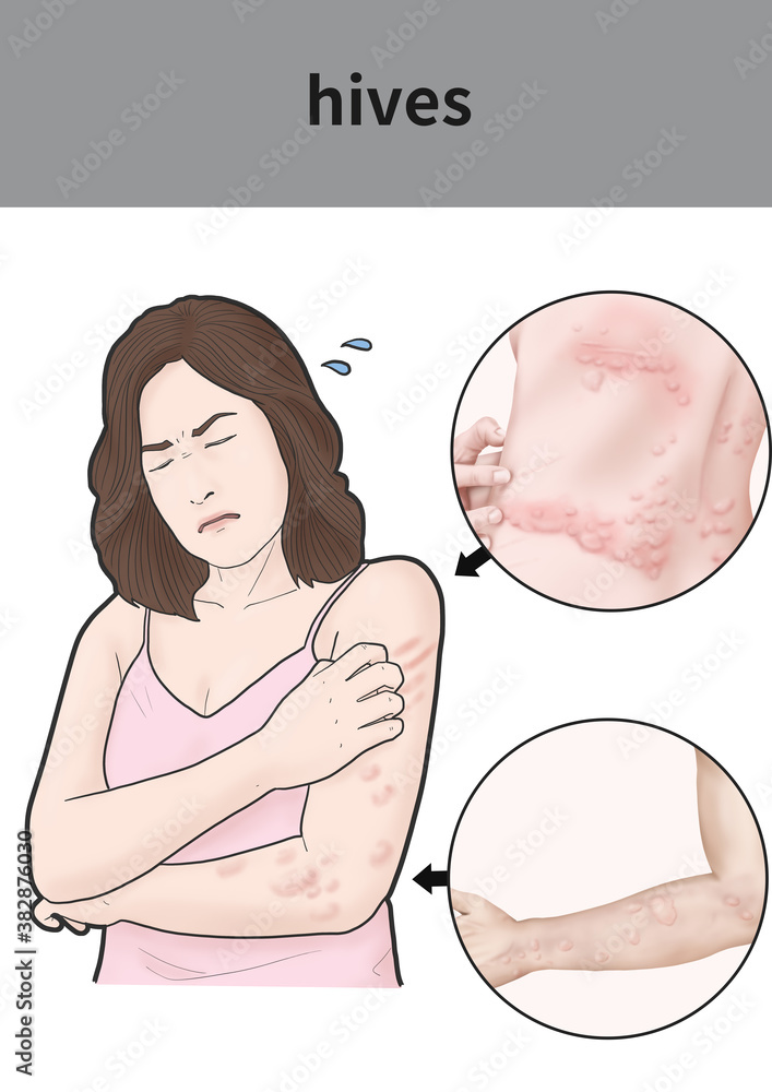 두드러기 설명을 위한 메디컬일러스트 두드러기 설명을 위한 메디컬일러스트