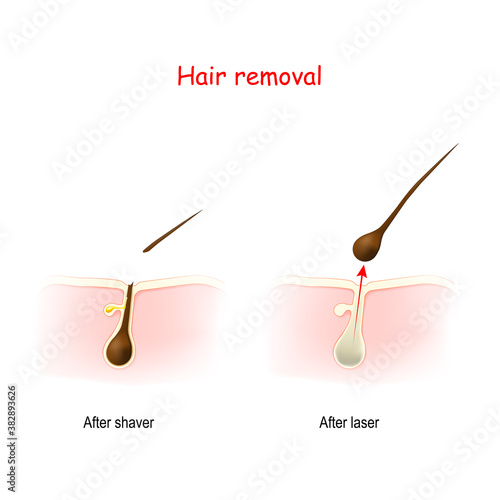 cross section of the Hair and skin after shaving or wax, and after laser hair removal.