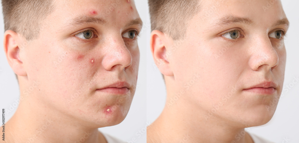 Teenage boy before and after acne treatment on light background
