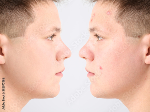 Teenage boy before and after acne treatment on light background