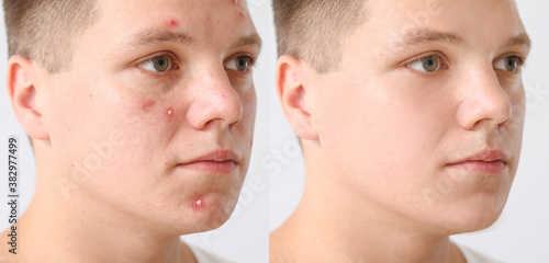 Teenage boy before and after acne treatment on light background