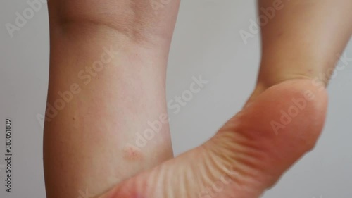 A woman's foot scratches the insect bite on her leg.