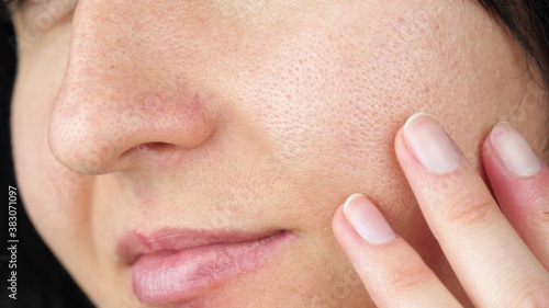 Billede på lærred The girl touches the fingers of problem skin with enlarged pores, examining it