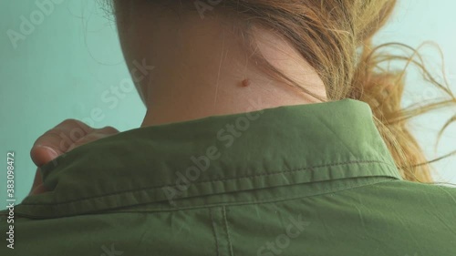 Big brown nevus on a female neck. Young woman hides mole under her hair. Birthmark or beauty mark cosmetology problem. Cosmetic laser procedure to remove moles without surgical scar.Dermatology clinic