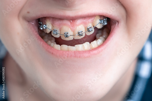 The teeth's braces on teeth of girl to equalize the teeth. Close-up. Dental concept.