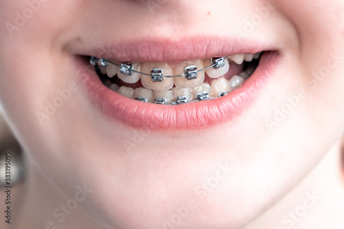 Metal orthodontic braces on crooked teeth close-up.