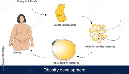 Development of obesity in women  
 vector illustration using white adipocytes and fat tissue