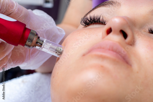 Fractional microneedle facial therapy close up photo